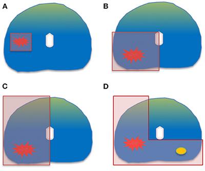 Focal Therapy for Prostate Cancer: Complications and Their Treatment